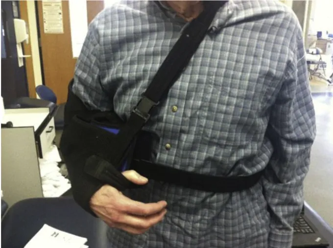Patient wearing abduction pillow sling after anatomic total shoulder arthroplasty to protect subscapularis repair in Phase 1 recovery.