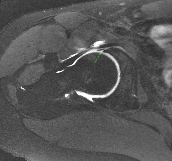 Axial MRA image of a right hip demonstrating a labral tear