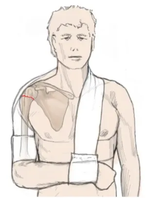 Illustration of patient wearing arm sling for non-operative immobilization of proximal humerus fracture