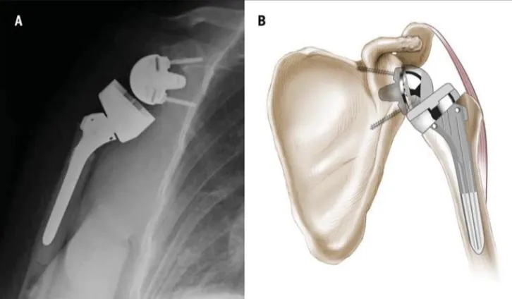 Anterior posterior radiograph of a right shoulder (A) and an illustration of a left shoulder (B) after
reverse total shoulder arthroplasty.