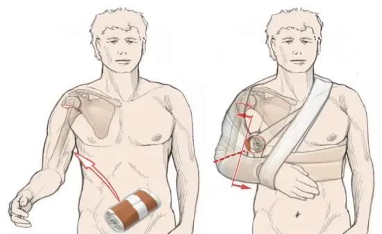 Illustration showing shoulder immobilization with a bandage wrap and sling for non-operative management of a proximal humerus fracture.