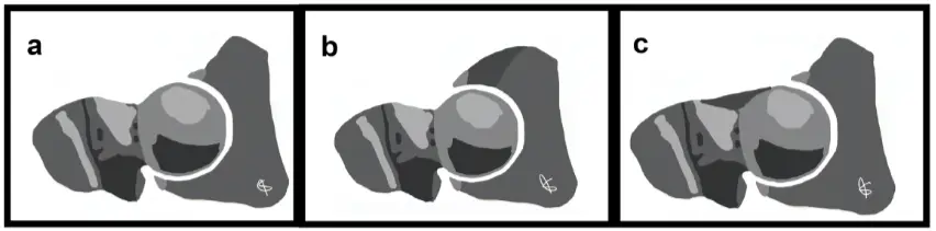 Schematic representation of hip