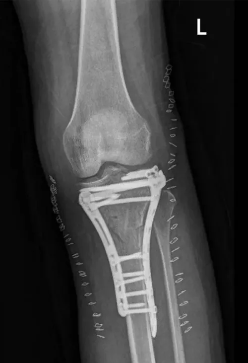 AP X-ray of a left knee after ORIF surgery showing internal hardware and surgical skin staples.