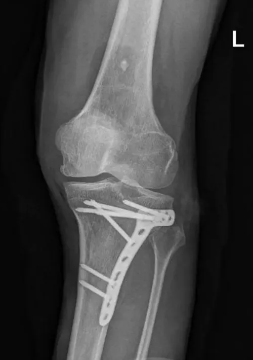 Anteroposterior X-ray of a left knee showing internal fixation hardware supporting a proximal tibia.