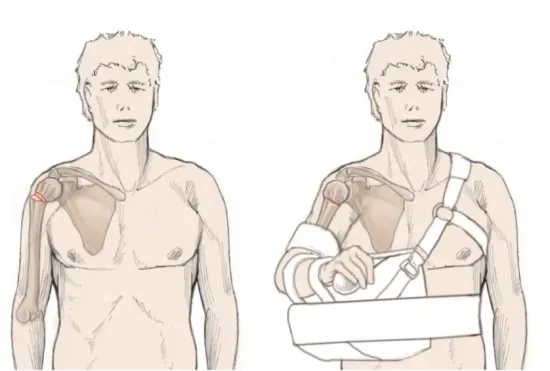 Illustration showing a proximal humerus fracture and the arm supported in a shoulder sling for non-operative treatment.