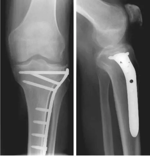 Front and side view X-rays of a knee with a surgical plate and screws after tibia fracture surgery.